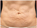 Thermage Body