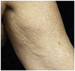 Thermage Body