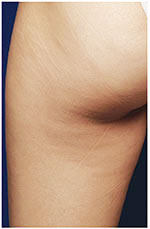 Thermage Body