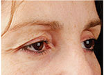 Thermage Eyes
