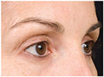 Thermage Eyes