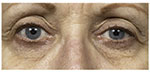 Thermage Eyes