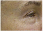 Thermage Eyes