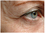 Thermage Eyes