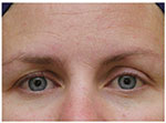 Thermage Eyes
