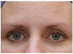 Thermage Eyes