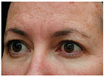 Thermage Eyes