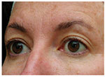 Thermage Eyes