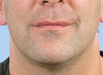 Thermage Face