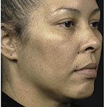 Thermage Face