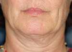 Thermage Face