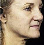 Thermage Face